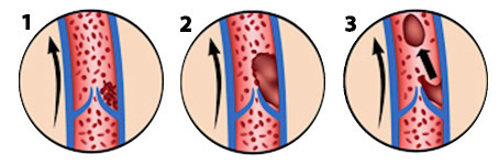 Reisethrombose